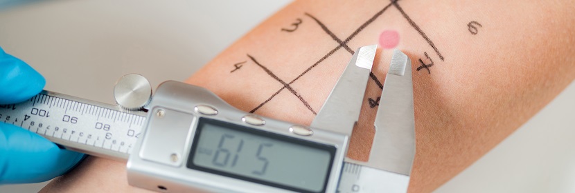 化妝品皮膚變態反應試驗